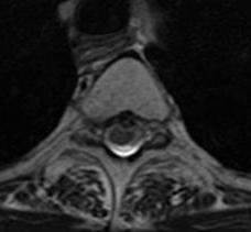 Thoracic Disc MRI Axial